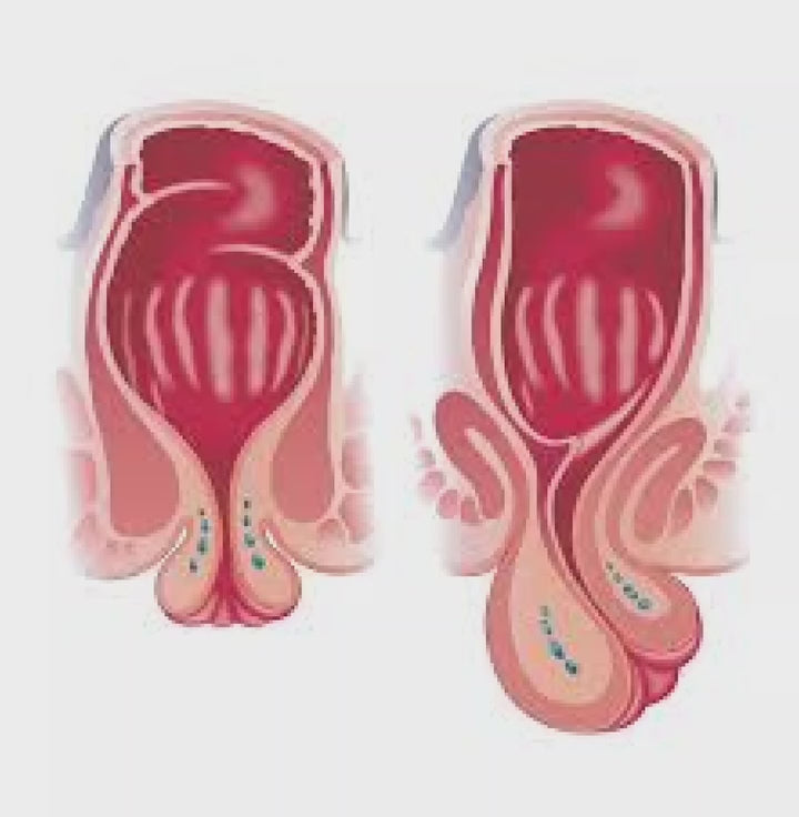 KIT PROLAPSUS RECTAL